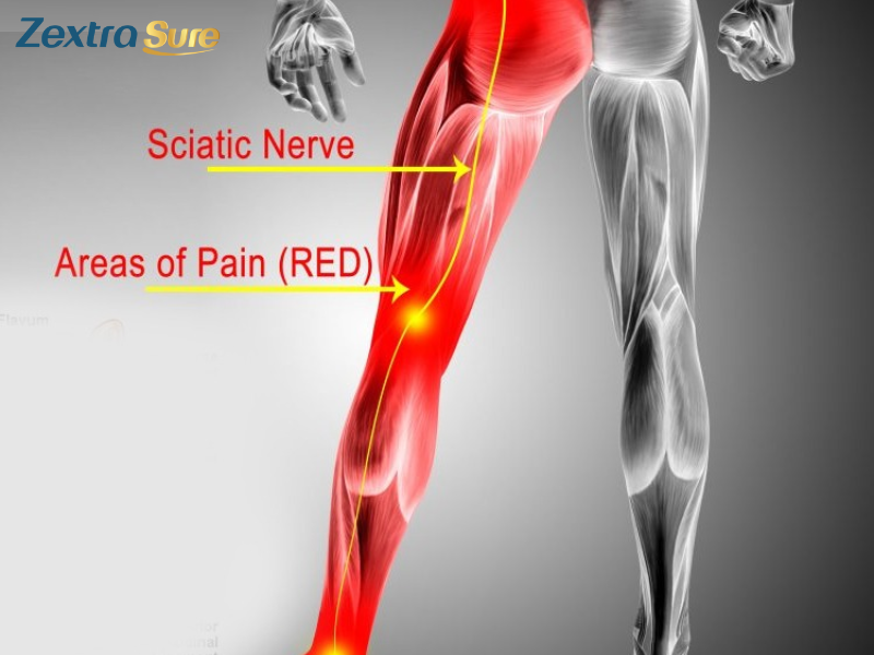 can-sciatica-cause-hip-pain (3)